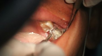 Stage-Bild zu Magazin-Artikel zum Thema Amalgam-Verbot