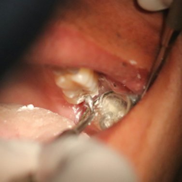 Stage-Bild zu Magazin-Artikel zum Thema Amalgam-Verbot