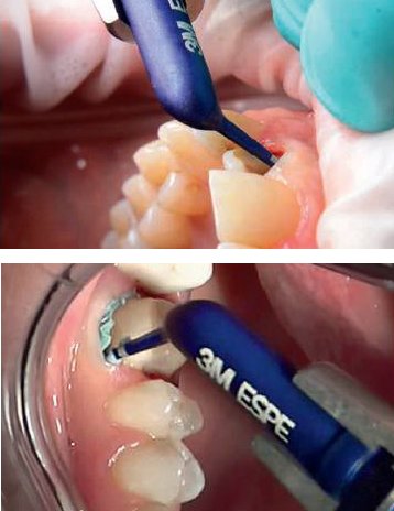 3M Adstringierende Retraktionspaste Anwendung