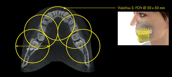 Dürr VistaVox S FoV